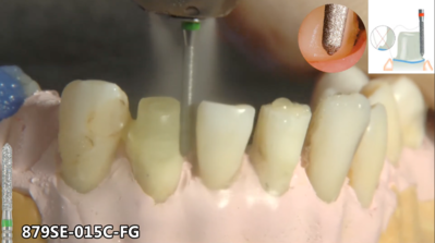 Preparation of a root post with NTI EasyChamfer